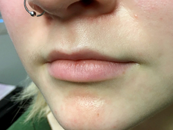 Injectables And Fillers 03