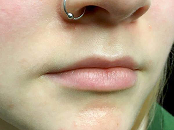 Injectables And Fillers 05