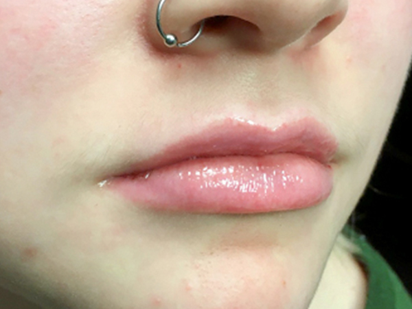 Injectables And Fillers 05