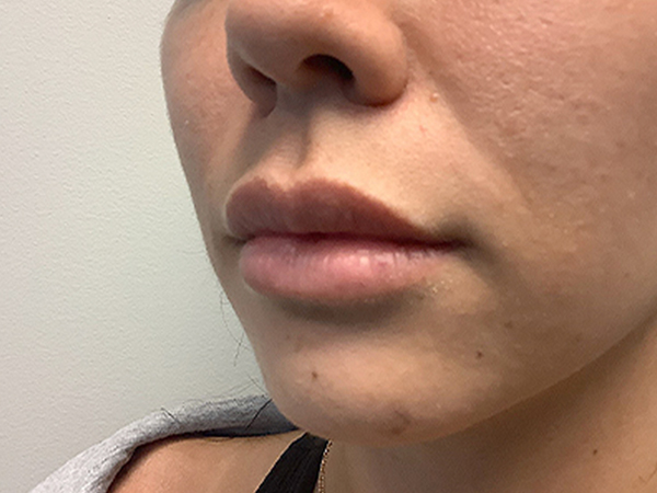 Injectables And Fillers 03