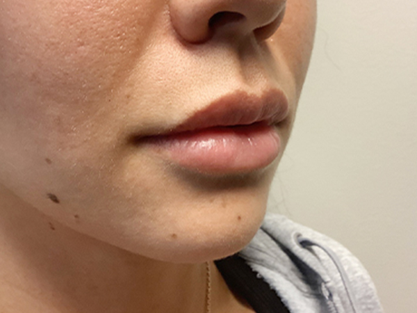 Injectables And Fillers 05