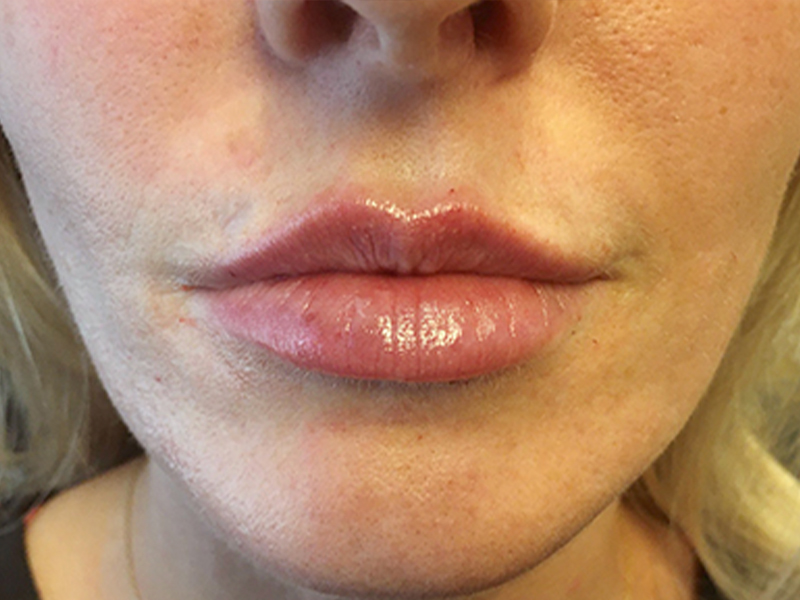 Injectables And Fillers 165