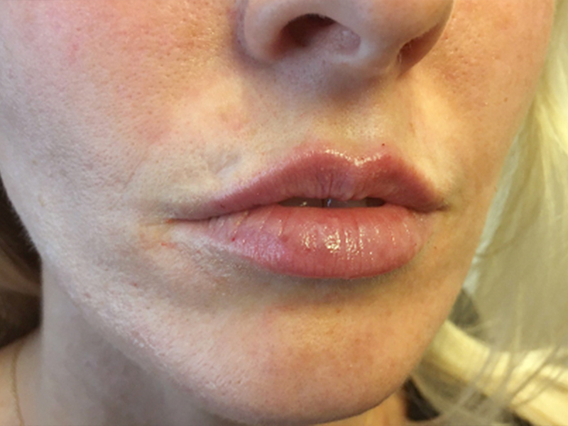 Injectables And Fillers 05