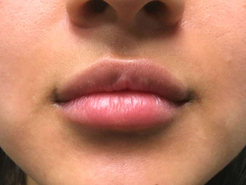 Injectables And Fillers 166