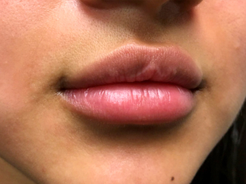 Injectables And Fillers 03