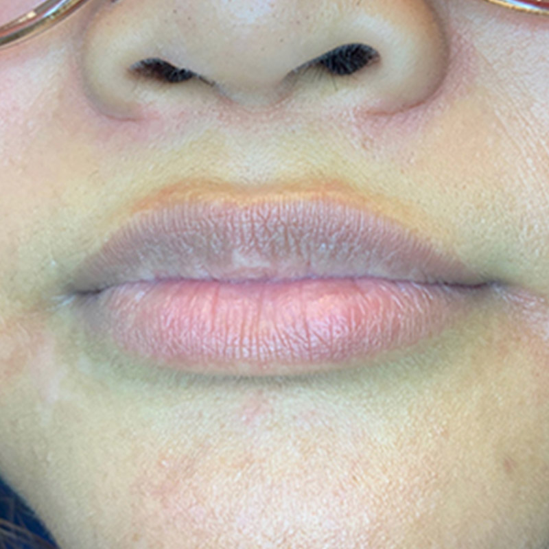 Injectables And Fillers 01