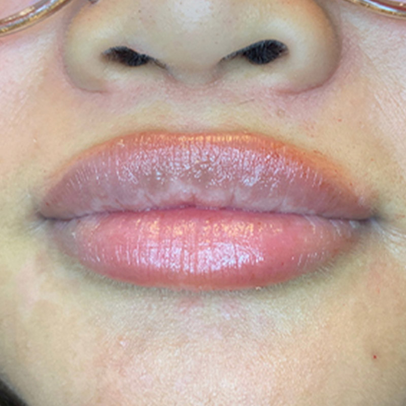 Injectables And Fillers 169