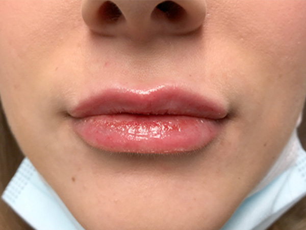 Injectables And Fillers 17