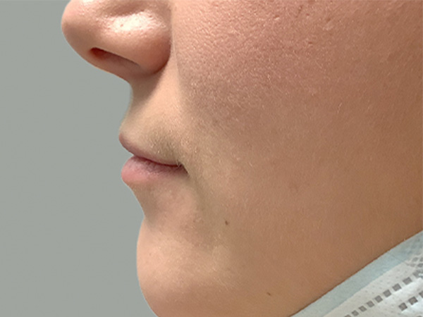 Injectables And Fillers 05