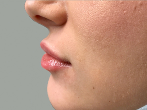 Injectables And Fillers 05