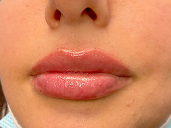 Injectables And Fillers 170