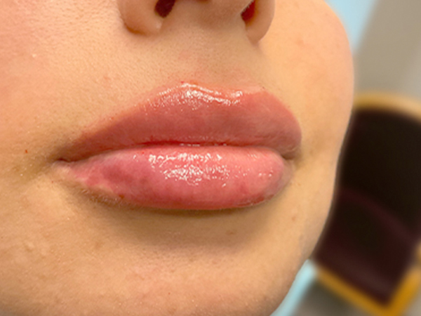 Injectables And Fillers 05