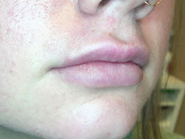 Injectables And Fillers 05