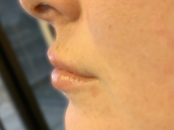 Injectables And Fillers 03