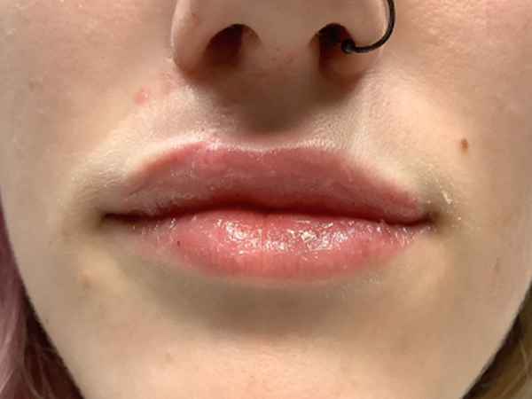 Injectables And Fillers 173