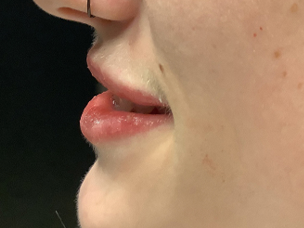 Injectables And Fillers 03