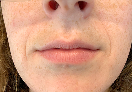 Injectables And Fillers 01