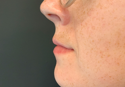 Injectables And Fillers 03