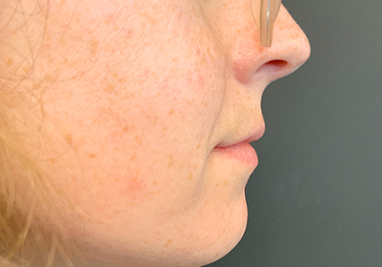 Injectables And Fillers 05