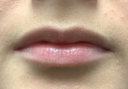 Injectables And Fillers 01