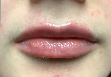 Injectables And Fillers 179