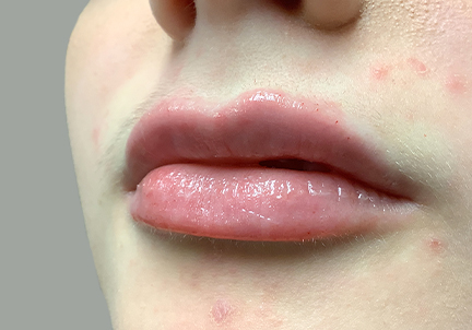 Injectables And Fillers 05