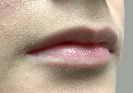 Injectables And Fillers 09