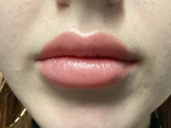 Injectables And Fillers 01