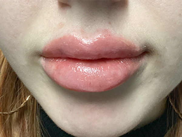 Injectables And Fillers 180