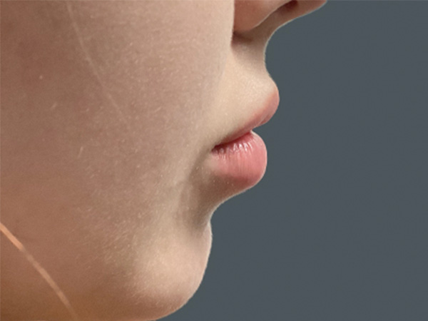 Injectables And Fillers 03