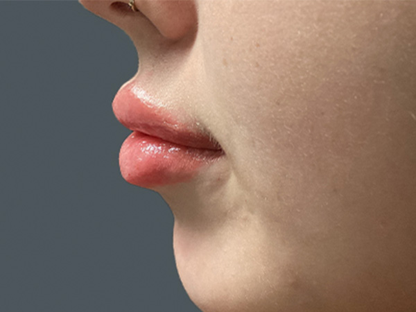 Injectables And Fillers 05