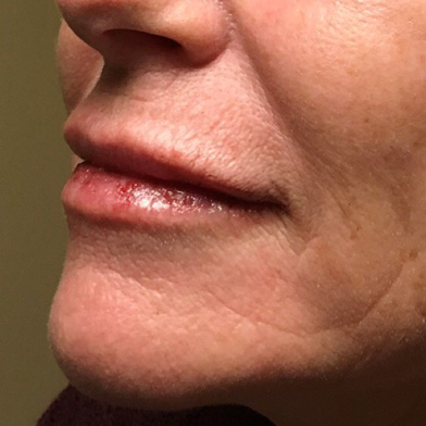 Injectables And Fillers 181