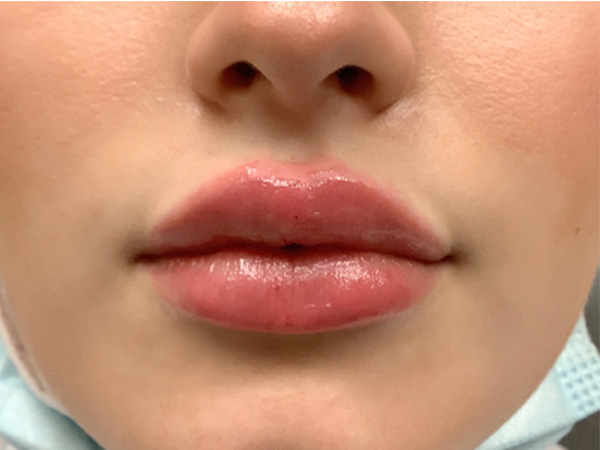 Injectables And Fillers 23