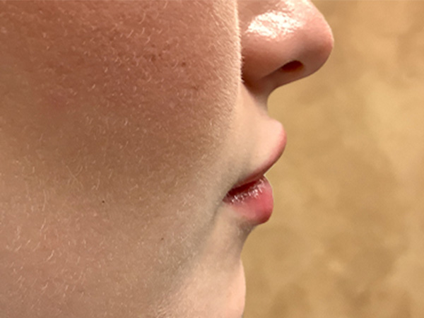 Injectables And Fillers 03