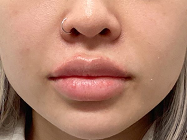 Injectables And Fillers 24