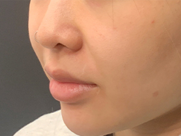 Injectables And Fillers 05