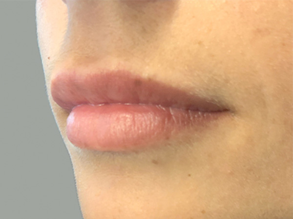 Injectables And Fillers 05