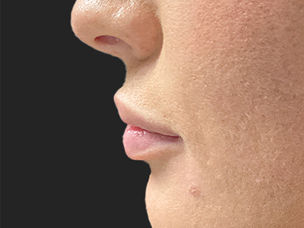 Injectables And Fillers 03