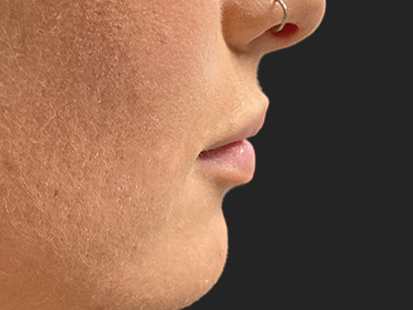 Injectables And Fillers 05