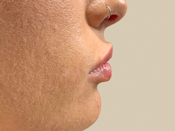 Injectables And Fillers 05