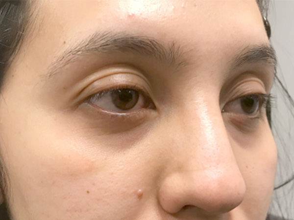 Injectables And Fillers 05