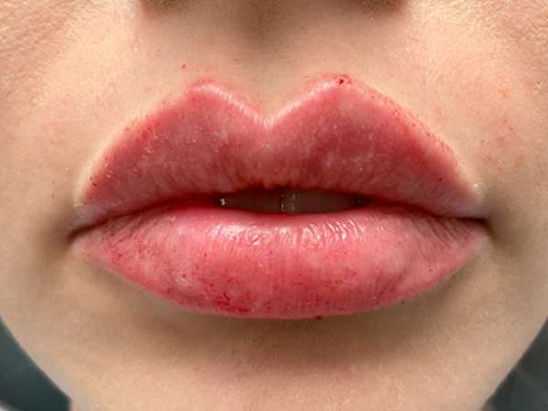 Injectables And Fillers 30