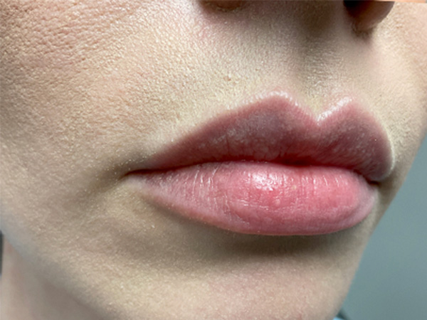 Injectables And Fillers 03