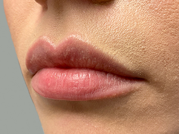 Injectables And Fillers 05