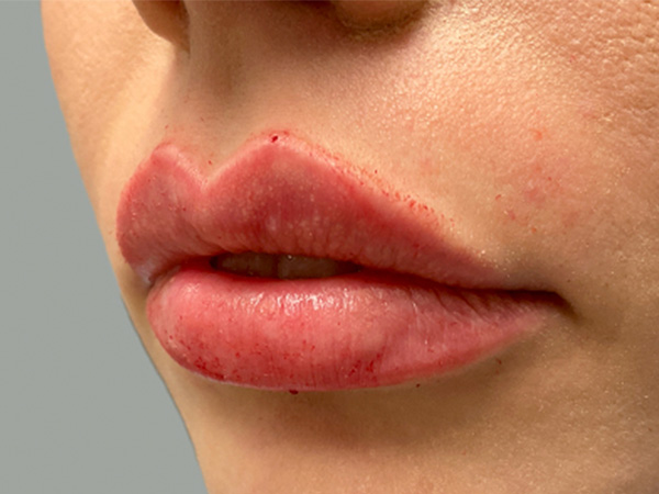 Injectables And Fillers 05