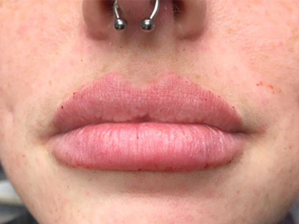 Injectables And Fillers 31