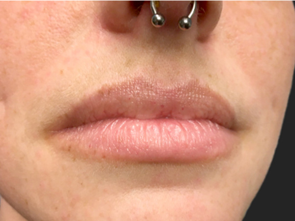 Injectables And Fillers 03