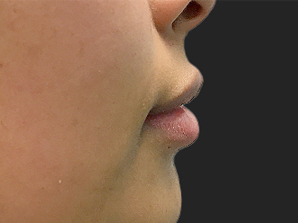 Injectables And Fillers 03