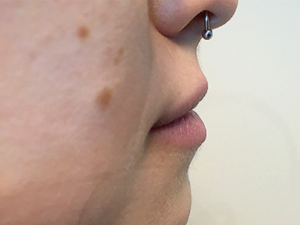 Injectables And Fillers 03