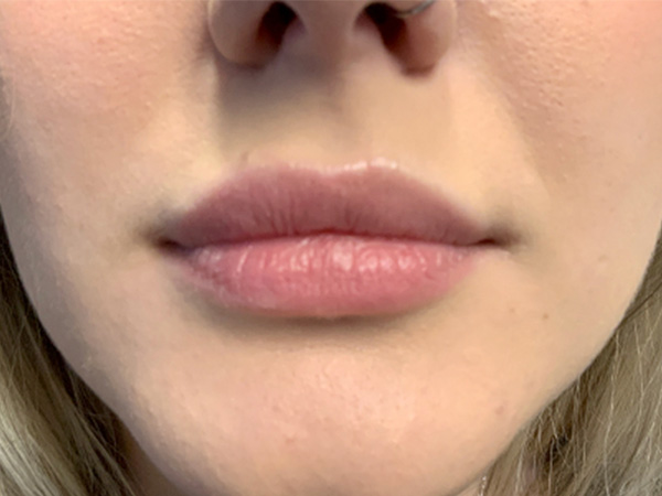 Injectables And Fillers 01